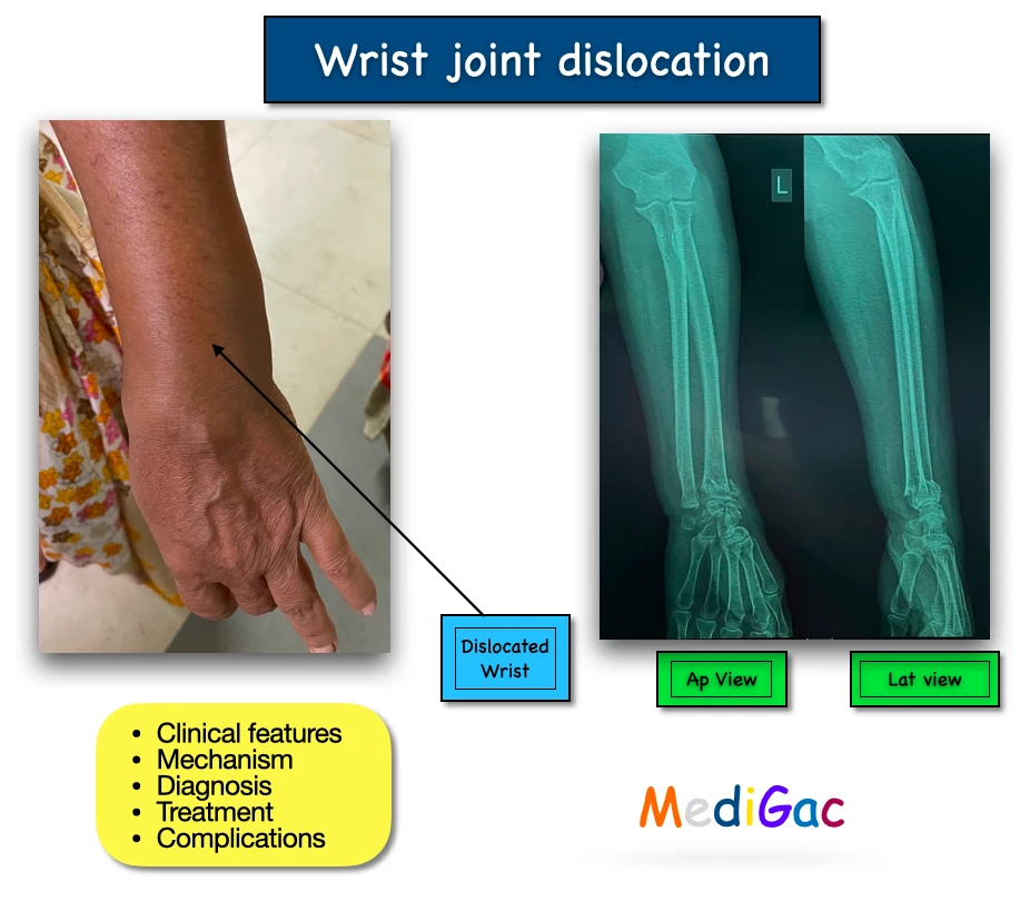 Wrist joint dislocation